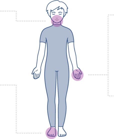 Typical signs and symptoms of Rett syndrome highlighted on a human body.